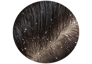 Dandruff