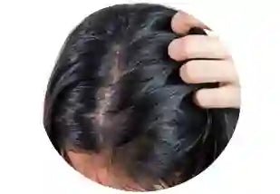Oily itchy scalp treatment items - Keya Seth Aromatherapy